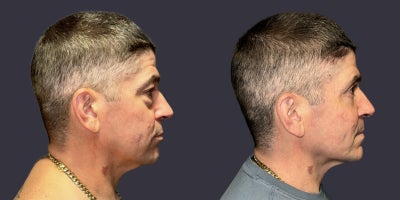 45-54 year old man treated with ActiveFX, CO2 Laser, Eyelid Surgery - This 48 year old man complained of sagging upper eyelids and puffy lower eyelids. Upper and lower blepharoplasty, (eyelid lift/surgery), including CO2 laser skin resurfacing around the eyes was done.