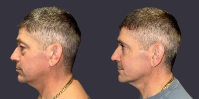 45-54 year old man treated with ActiveFX, CO2 Laser, Eyelid Surgery - This 48 year old man complained of sagging upper eyelids and puffy lower eyelids. Upper and lower blepharoplasty, (eyelid lift/surgery), including CO2 laser skin resurfacing around the eyes was done.