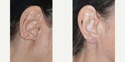 55-64 year old woman treated with Ear Surgery - Complicated case of an earlobe reconstruction for a patient who had undergone previous aggressive earlobe reduction elsewhere and wanted her earlobes restored. Ear cartilage grafting and rotational flap was used to reconstruct the bilateral earlobes.