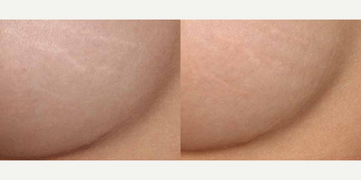 Woman treated with ResurFX - Photo provided courtesy of Lumenis, Ltd., performed by Mitchel P. Goldman, MD