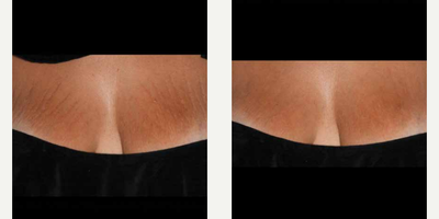 25-34 year old woman treated with ResurFX - Photo provided courtesy of Lumenis, Ltd., performed by Matteo Tretti Clementoni, MD