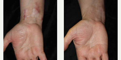 Woman treated with ResurFX - Photo provided courtesy of Lumenis, Ltd., performed by Matteo Tretti Clementoni, MD
