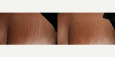 Woman treated with ResurFX - Photo provided courtesy of Lumenis, Ltd., performed by Matteo Tretti Clementoni, MD
