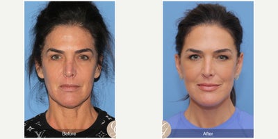 56 year old woman treated with Deep Plane Facelift, Facelift, Neck Lift, Eyelid Surgery, Lip Lift - 56 year old woman treated with Deep Plane Face and Neck Lift, Lower Blepharoplasty, Under Eye Laser, Lip Lift