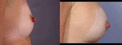 37 yr old Breast Augmentation, Nipple Reduction - 	37 yr old mother of two had Breast Augmentation with the CPG Cohesive Gel Implants, placed under the muscle thru inframammary incisions. She also had Nipple Reduction as she was unhappy with her large nipples, having breast fed 2 children