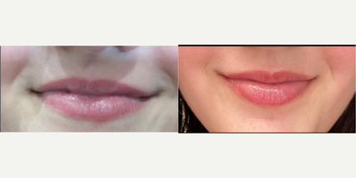 Woman treated with CoolPeel - Do you suffer from dry cracked lips? Girl, us too! Come and try out the CoolPeel for lips and get exfoliated plump lips that feel amazing. The lips feel rough for 1-3 days as the micro dots you see called MENDS slowly slough off. No actualpeeling will occur despite the laser name, but the lips are exfoliated by this treatment and collagen is stimulated in the process.