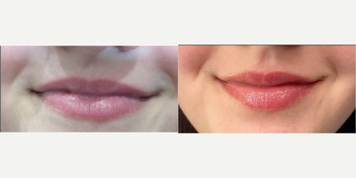 Woman treated with CoolPeel - Do you suffer from dry cracked lips? Girl, us too! Come and try out the CoolPeel for lips and get exfoliated plump lips that feel amazing. The lips feel rough for 1-3 days as the micro dots you see called MENDS slowly slough off. No actualpeeling will occur despite the laser name, but the lips are exfoliated by this treatment and collagen is stimulated in the process.