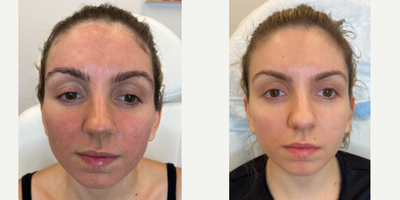ACNE SCAR COMBINATION | HYBRID LASER + CO2 - Our patient had some deep acne scars that she always wanted to soften and decided to do it before her wedding day. Like most of our patients who come for acne scar treatments, her scars made her feel self-conscious. After one combination treatment we saw a substantial improvement, but we plan on doing a follow up treatment to target her remaining scars. To maximize her results, she is using the skincare regimen that our team made for her. ACNE SCAR COMBINATION  Bellafill Pixel8 RF HALO Laser CO2 LASER EmerSkin What makes HALO laser our patient-favorite treatment Hybrid fractional laser to improve quality of the skin with minimal downtime Improved skin tightening Acne scarring reduction Can be tailored for aggressive treatments on those with very significant wrinkles Long term collagen production Can be used all over the face and body including the neck, chest, arms, elbows and knees Combine with CO2 for enhanced outcomes