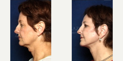 55-64 year old woman treated with Facelift, Phenol Peel - 58 yo facelift, quad bleph, canthopexy, perioral phenol peel, dorsal nasal reconstruction. Pt had previous radiation therapy for skin cancer with resorption of the cartilagecorrection of neck thyroidectomy scar.