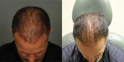 45-54 year old man treated with Hair Transplant - Neo Graft 3092 grafts. 1 month post / 12 months post.
6 Months post / 12 months post.