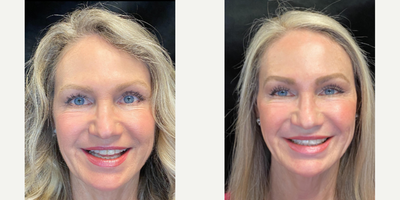 55-64 year old woman treated with Dysport, Facial, Dermal Fillers, Botox - Patient treated with series of facials, botox, and dermal fillers.