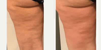 25-34 year old woman treated with Exilis - This is after 1 treatment. After a series of treatments, you can expect:Cellulite ReductionTrapped Fat ReductionCircumferential ReductionLymphatic MassageLymphatic DrainagePre and Post-Liposuction TreatmentRelieve Muscle Aches and SpasmsFade Scar Tissue