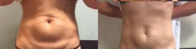 35-44 year old woman treated with Velashape - 6- 1 hour VelaShape III Sessions spaced 1 weeks apart