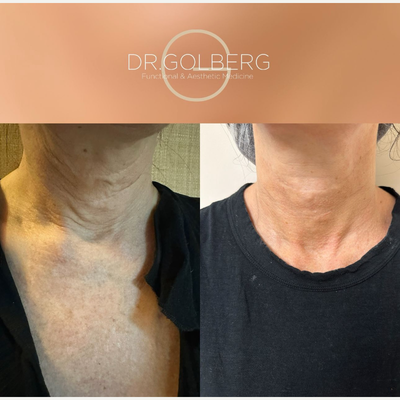 55-64 year old woman treated with Nonsurgical Neck Lift - Non surgical neck lift with PDO and MINT threads