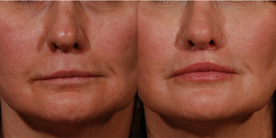 45-54 year old woman treated with Lip Lift - 50 year old woman interested in improving her upper lip, after years of dermal filler was not happy with the unnatural look. The doctorrecommended waiting 3 months for remaining filler to dissipate. Pt returned and was then a good candidate for the in-office lip lift procedure. This is her result 3 months post surgery.