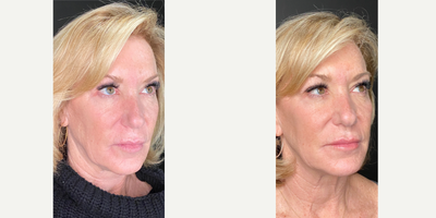 55-64 year old woman treated with Sculptra, Collagen Injection - Results after using 4 vials of Sculptra to cheeks, temples, pyriform and jawline.