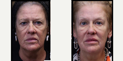 55-64 year old woman treated with Laser Resurfacing, Fractional Laser, Fraxel Laser, Nonsurgical Facelift - Lasercoring fractional ablative laser with ultraclear laser full face and neck, results after 3 months.Lasercoring, is a nonsurgical laser-enabled fractional tissue coring and laser-induced deep dermal collagen remodeling resulting in total transformation.