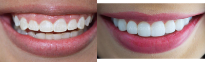 25-34 year old woman treated with Dental Bonding - 25-34 year old woman treated with Dental Bonding