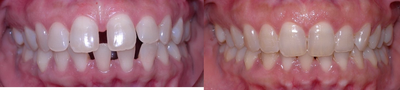 Invisalign - 
	Patient was self-conscious and never wanted to smile in pictures. Patient did the invisalign treatment, now she can&#39;t stop smiling.
