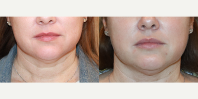 45-54 year old woman treated with RHA Collection Fillers - Lip lines gone with RHA2 lip filler