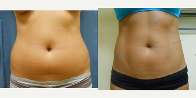 25-34 year old woman treated with Body Jet - Patient received HD liposuction to the abdomen.