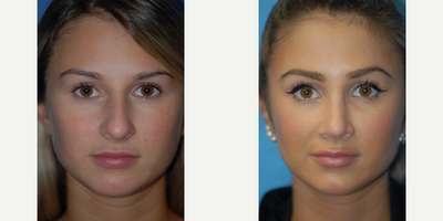 Woman treated with Septoplasty and Rhinoplasty - Woman treated with Septoplasty and Rhinoplasty