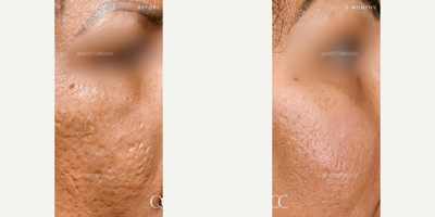 Acne Scars Combination Treatment with CO2 Laser + Subcision by Dr. Qazi - Acne Scars Combination Treatment with CO2 Laser + Subcision