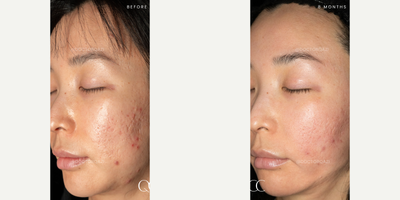 35-44 year old woman treated with Scar Removal, CO2 Laser, Sculptra, TCA Peel, Subcision - Acne Scars Combination Treatment with CO2 Laser + Sculptra + TCA Cross + Subcision