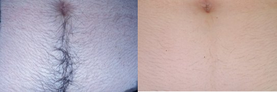 Abdomen after last Ultimate Light pulsed light treatment - Dramatic reduction in unwanted hair on the abdomen of a 35 yr old female 4 months after last Ultimate Light&trade; pulsed light treatment.