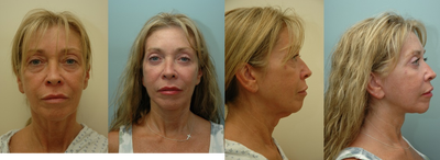 Facelift - 
	Facelift
