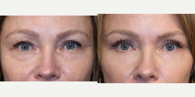 Upper and Lower Eyelid Surgery - Upper and lower eyelid surgery with laser.