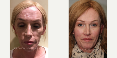 Patient treated with MTF Facial Feminization Surgery - Patient treated with MTF Facial Feminization Surgery through rhinoplasty, laryngeal shave, brow reduction, lip lift and CO2 laser resurfacing to achieve a more feminine and refined facial aesthetic appearance. Facial fillers and botox were also used to reduce the appearance of fine lines and wrinkles.