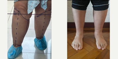 45-54 year old woman treated with Lipedema Surgery, Liposuction - 6-month post-op results from circumferential lipedema liposuction surgery on the calves, and ankles.