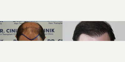 Man treated with Hair Transplant - 4100 grafts, after one year