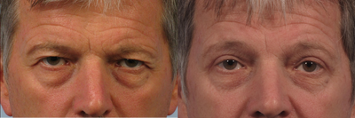 Male upper eyelid lift -
1 month after upper blepharoplasty to correct heavy eyelid skin.