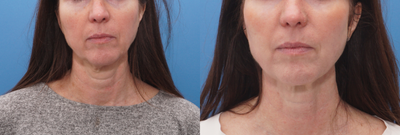 45-54 year old woman treated with Morpheus8 - Morpheus8 for skin tightening on lower face and neck