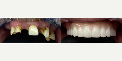 55-64 year old man treated with Smile Makeover, Mini Dental Implants, Fix on Six - Treatment: Upper Restoration - Fix on Six Process: Consultation, decide on treatment, extract and place implants, and patient is to return for a post-op check. Results: Beautiful, semi-removable Zirconia bridge. Important to note that this can only be removable by a provider. Results will vary from patient to patient.