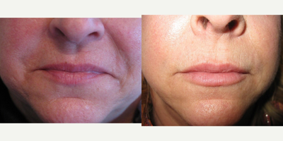 55-64 year old woman treated with Restylane Silk - 63 year old woman who had Restylane Silk to lips.  Notice the hydrated youthful look without a large amount of over all size change as well as the improvement at the oral commissures.