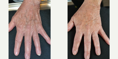 65-74 year old woman treated with Radiesse - 69 year old woman treated with Radiesse to both hands to improve the appearance of veins (photos are of the patient's left hand)