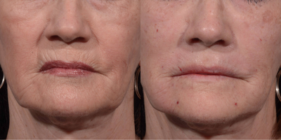 65-74 year old woman treated with Volbella - Upper and lower lip smokers lines treated with Volbella