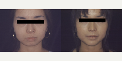 Woman treated with Chin Implant - Woman treated with Chin Implant
