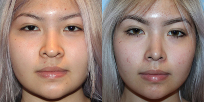18-24 year old woman treated with Asian Rhinoplasty - Open rhinoplasty with weir excision to bring in the nostrils and refine the nasal tip