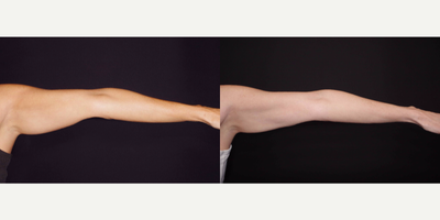 45-54 year old woman treated with Venus Legacy (and CoolSculpting) - 48 year old female received CoolSculpting and Venus Legacy to the arms; photos depict the patient's results 6 months post-CoolSculpting and 3 months post-Venus Legacy.