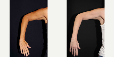 45-54 year old woman treated with Venus Legacy (and CoolSculpting) - 48 year old female received CoolSculpting and Venus Legacy to the arms; photos depict the patient's results 6 months post-CoolSculpting and 3 months post-Venus Legacy.