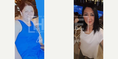 35-44 year old woman treated with Gastric Bypass - Lost 50 kgWe are proud of her