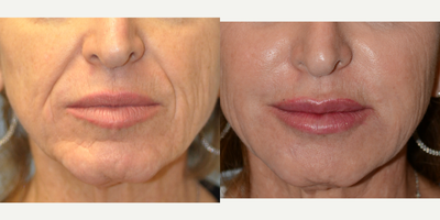 55-64 year old woman treated with Juvederm - 59 year old Female Patient Treated for Nasolabial Folds, Marionette Lines and Perioral Rhytids
