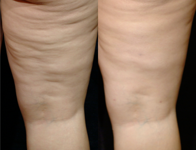 35-44 year old woman treated with Cellulaze - Grade III cellulite with one treatment of Cellulaze
