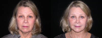 Facelift - This patient was interested in improving her jawline and neck line as well as the tired look of her eyes. I performed a lower face and neck lift and she also had her upper eyelid droop (ptosis) repaired by an ophthalmologist at the same time. Her postop photos, taken 6 weeks after her procedure, show a dramatic improvement in her jawline, cheeks, and neckline, and she has an overall more refreshed look.