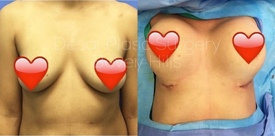 Woman treated with Breast Augmentation - 350cc HP Profile Gummy Bear, Implants, Dual Plane Technique.