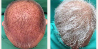 55-64 year old man treated with Hair Transplant - Patient is one year post op neograft